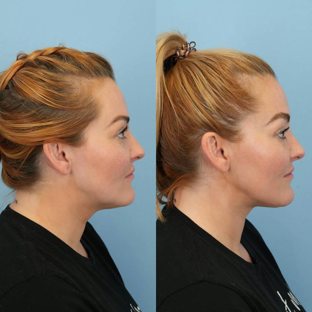 Neck Lift Before & After Gallery - Patient 932168 - Image 1