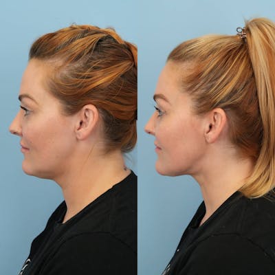 Neck Lift Before & After Gallery - Patient 932168 - Image 2