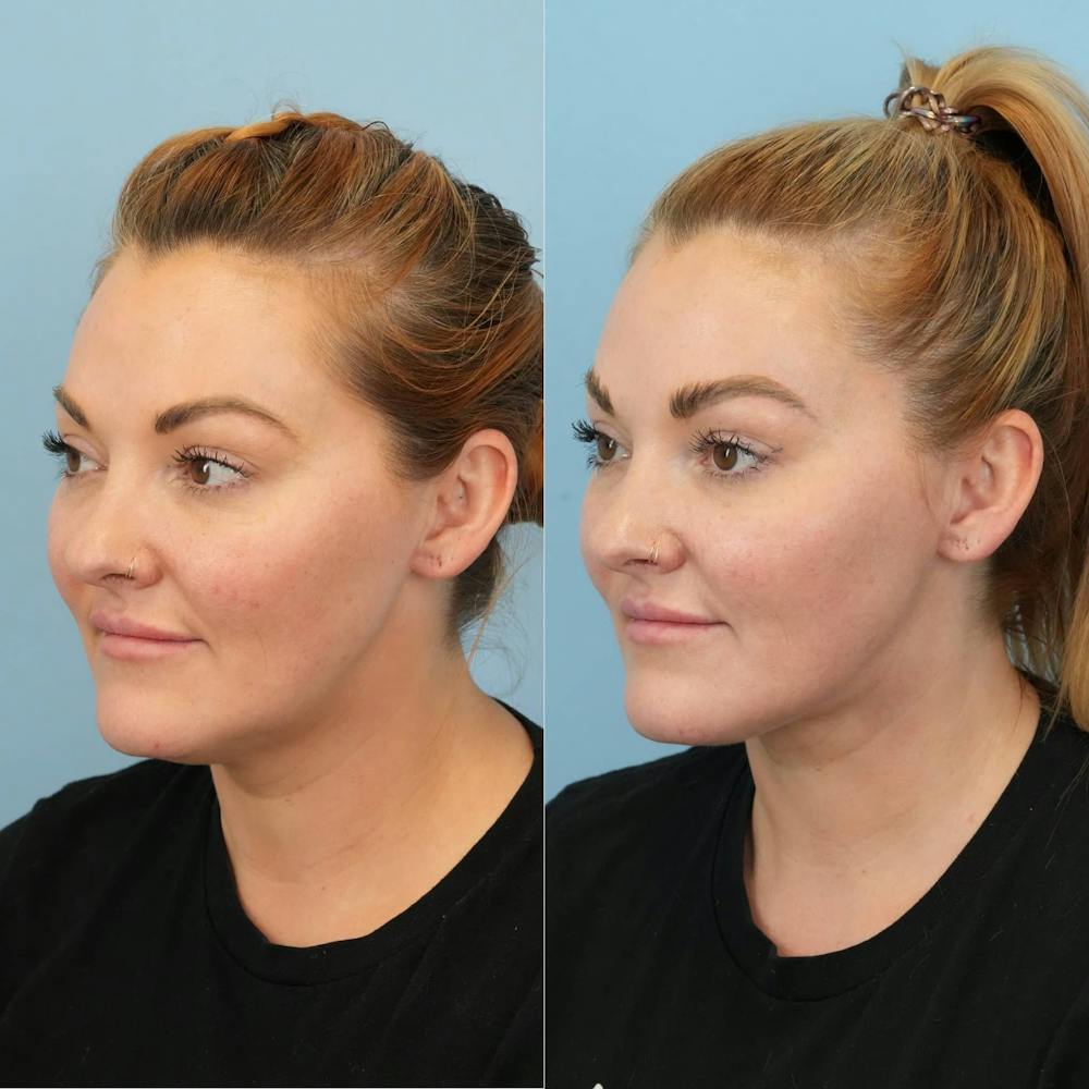 Neck Lift Before & After Gallery - Patient 932168 - Image 3