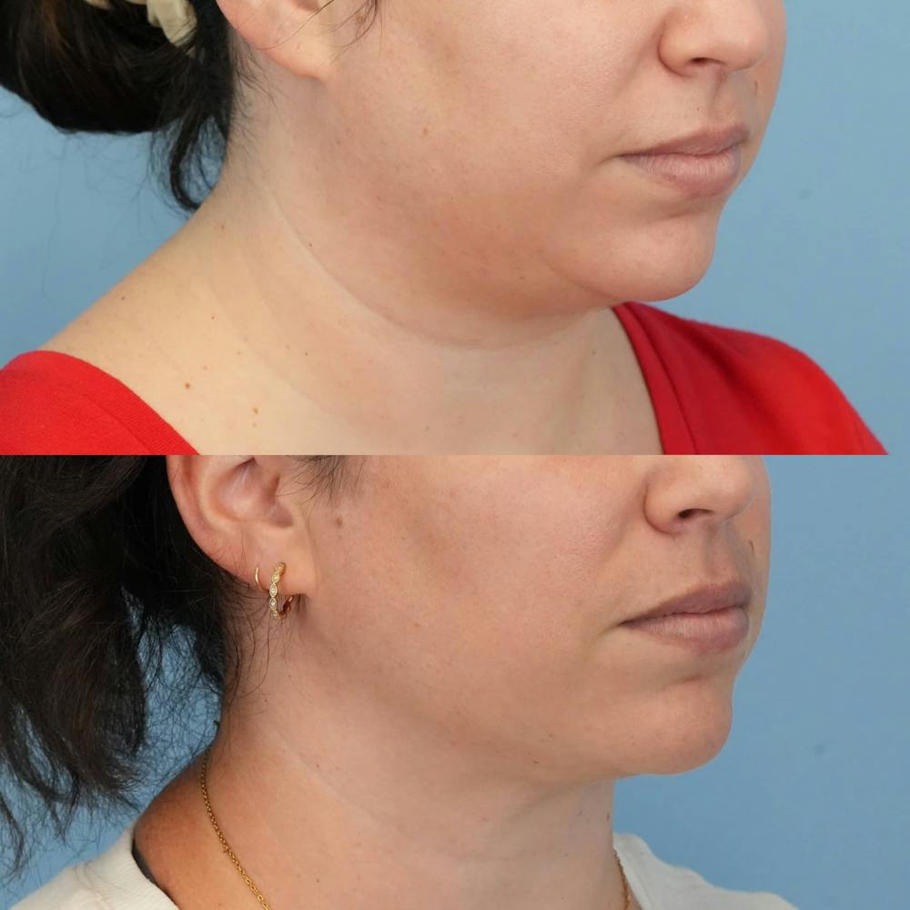 Neck Liposuction Before & After Gallery - Patient 855342 - Image 2