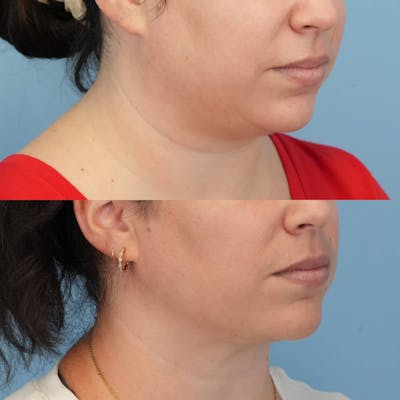 FaceTite & ThermiTight Before & After Gallery - Patient 128066 - Image 2