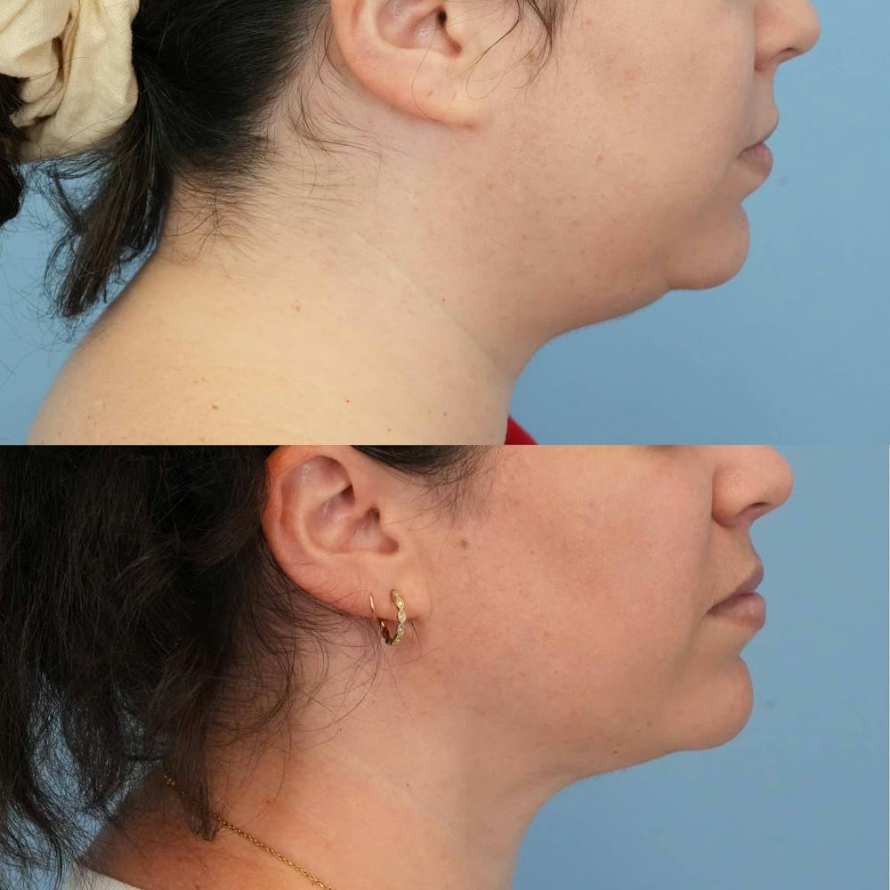 FaceTite & ThermiTight Before & After Gallery - Patient 128066 - Image 3