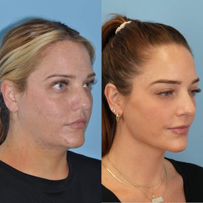 Neck Liposuction Before & After Gallery - Patient 354888 - Image 4