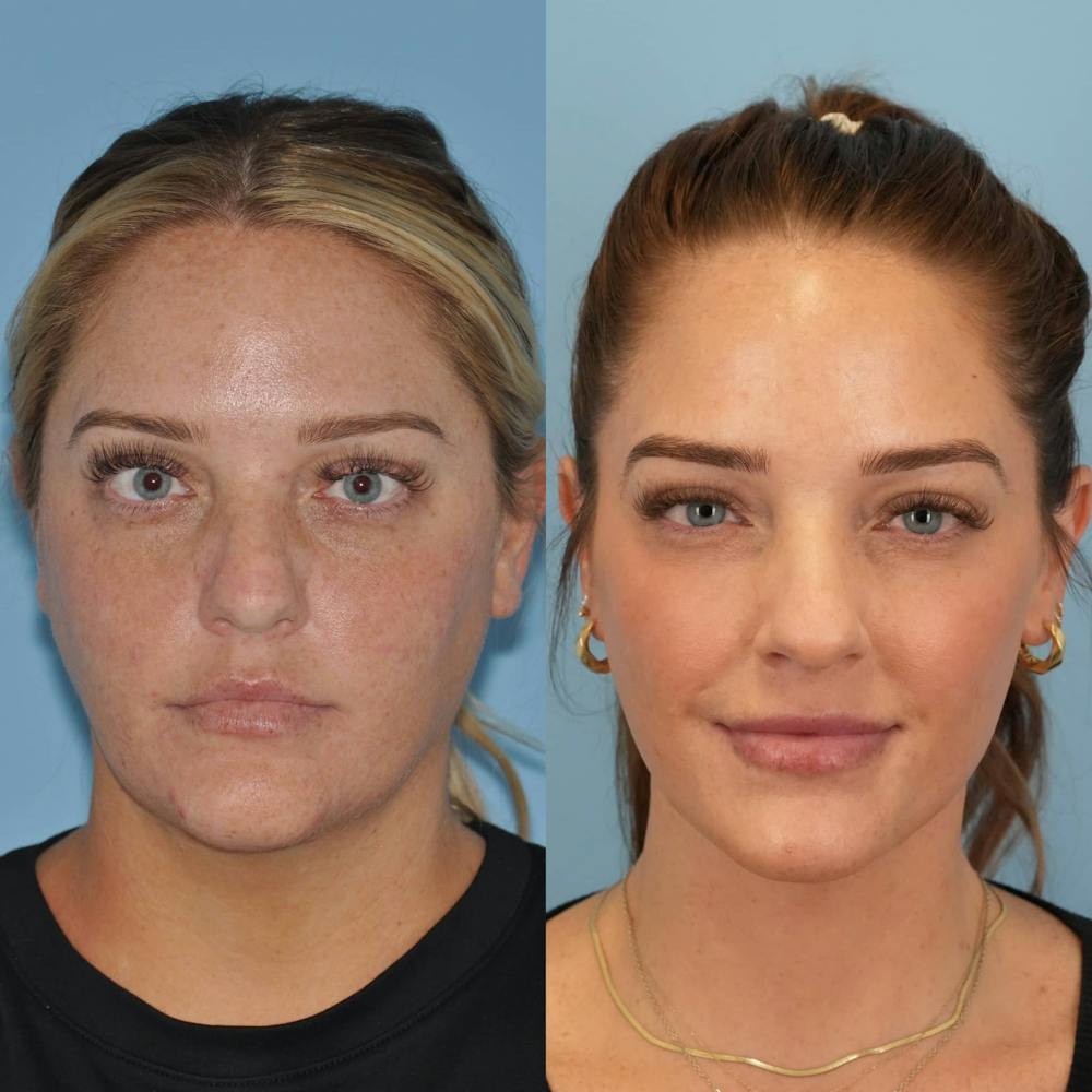 FaceTite & ThermiTight Before & After Gallery - Patient 370724 - Image 3