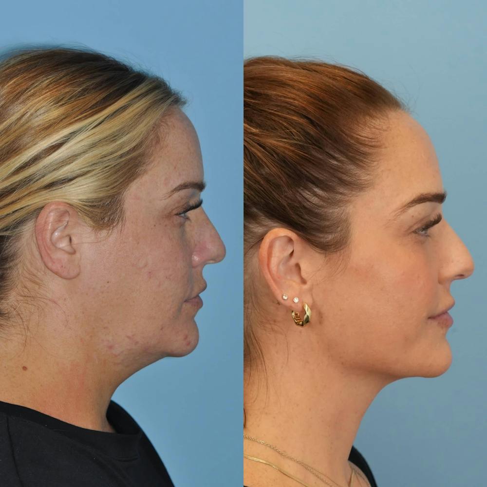FaceTite & ThermiTight Before & After Gallery - Patient 370724 - Image 5