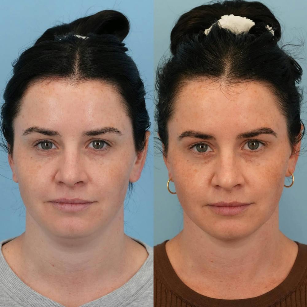 FaceTite & ThermiTight Before & After Gallery - Patient 264728 - Image 3