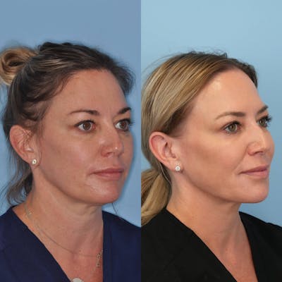 FaceTite & ThermiTight Before & After Gallery - Patient 194761 - Image 4