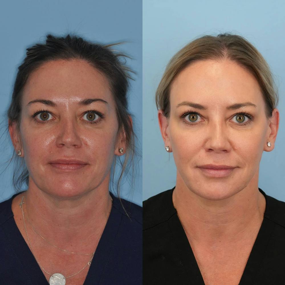 Neck Liposuction Before & After Gallery - Patient 384822 - Image 3