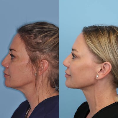 Neck Liposuction Before & After Gallery - Patient 384822 - Image 1