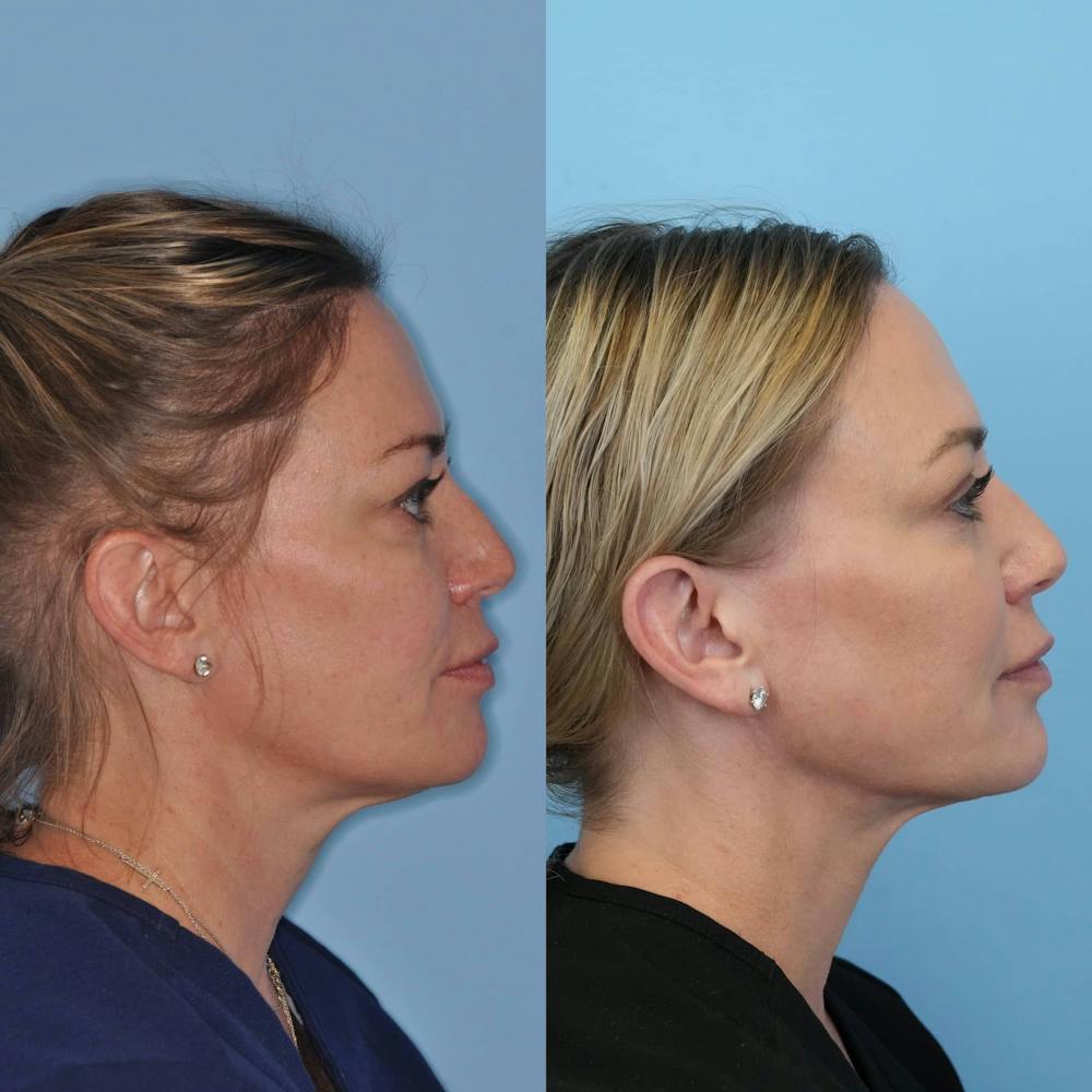 Neck Liposuction Before & After Gallery - Patient 384822 - Image 5
