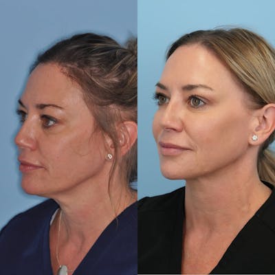 FaceTite & ThermiTight Before & After Gallery - Patient 194761 - Image 2