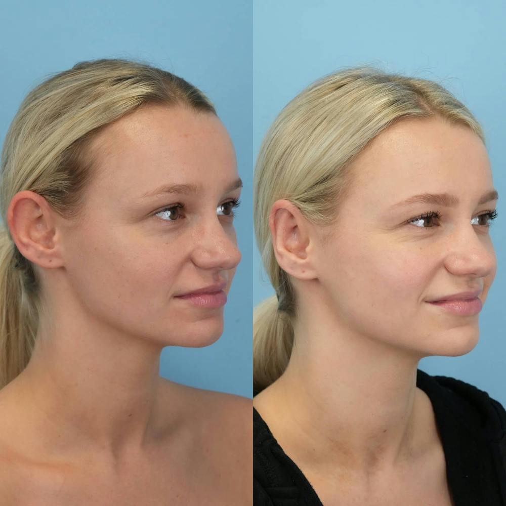 Otoplasty Before & After Gallery - Patient 323908 - Image 2