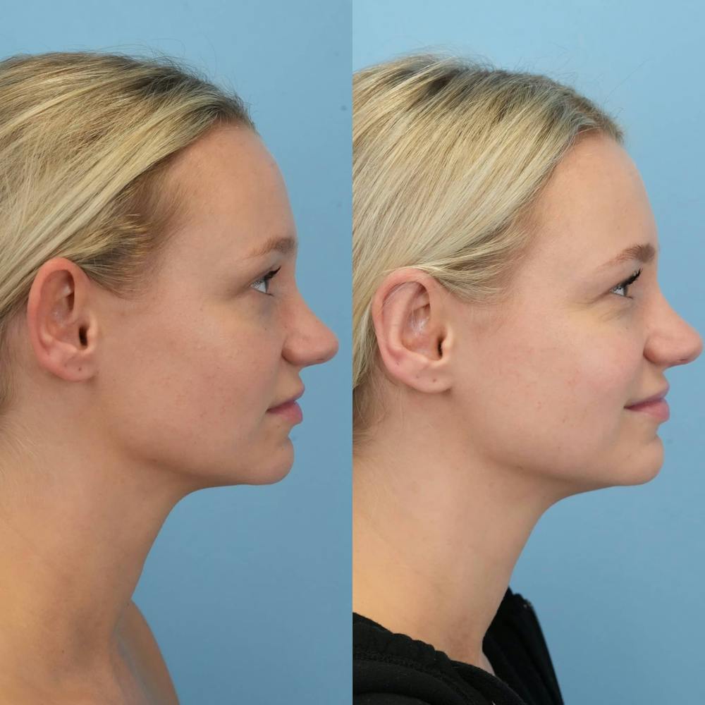 Otoplasty Before & After Gallery - Patient 323908 - Image 3