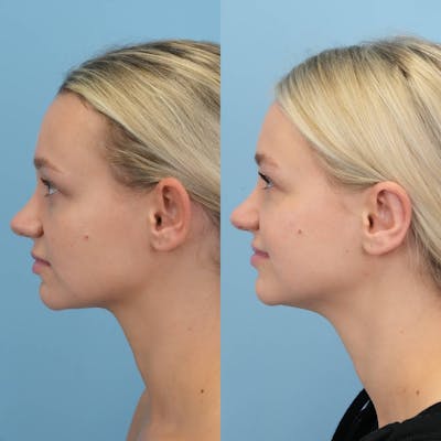 Otoplasty Before & After Gallery - Patient 323908 - Image 4