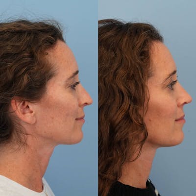 Revision Rhinoplasty Before & After Gallery - Patient 153460 - Image 8