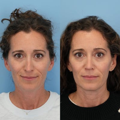 Revision Rhinoplasty Before & After Gallery - Patient 153460 - Image 4