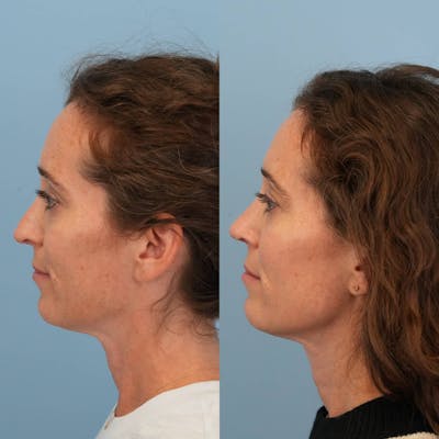 Revision Rhinoplasty Before & After Gallery - Patient 153460 - Image 2