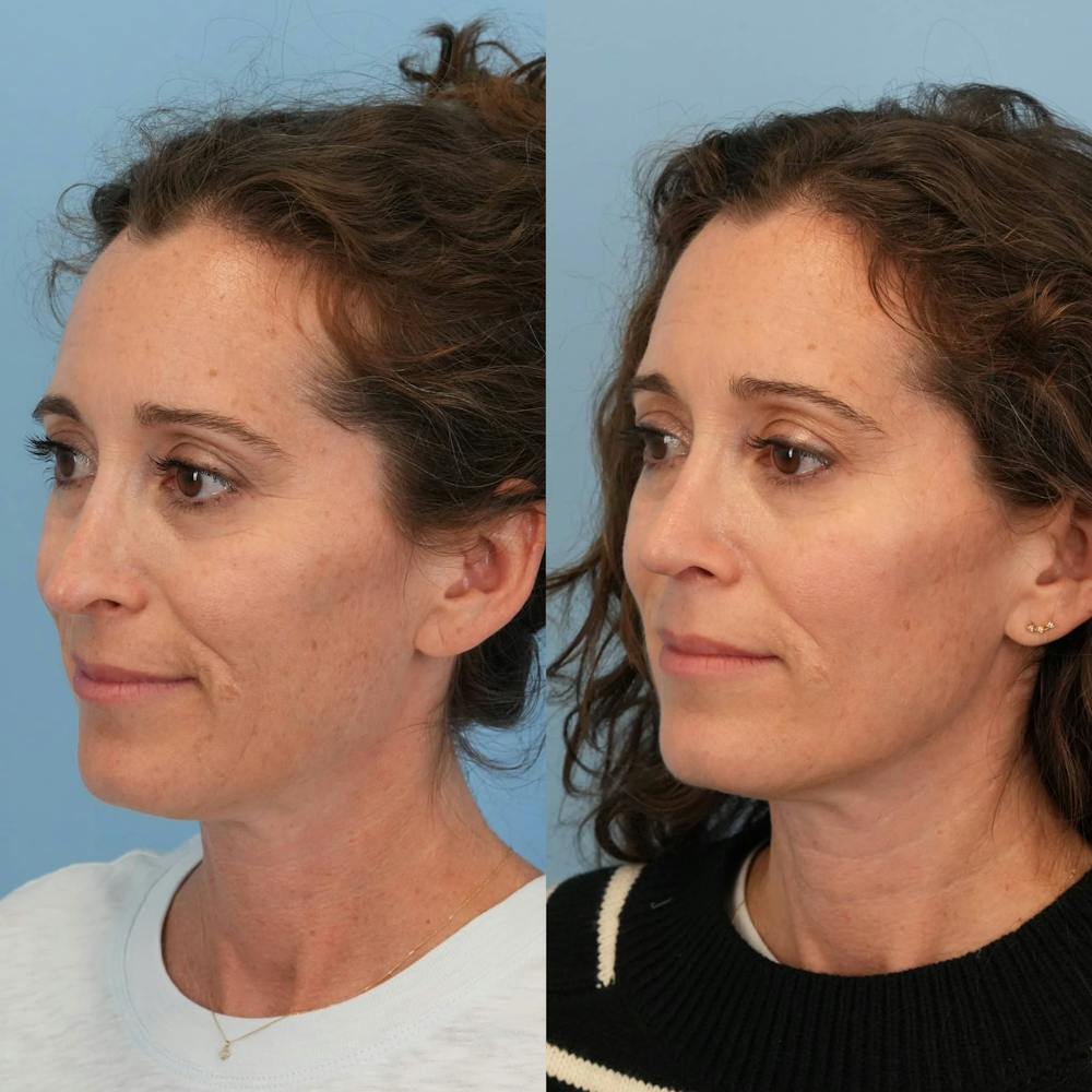 Revision Rhinoplasty Before & After Gallery - Patient 153460 - Image 3