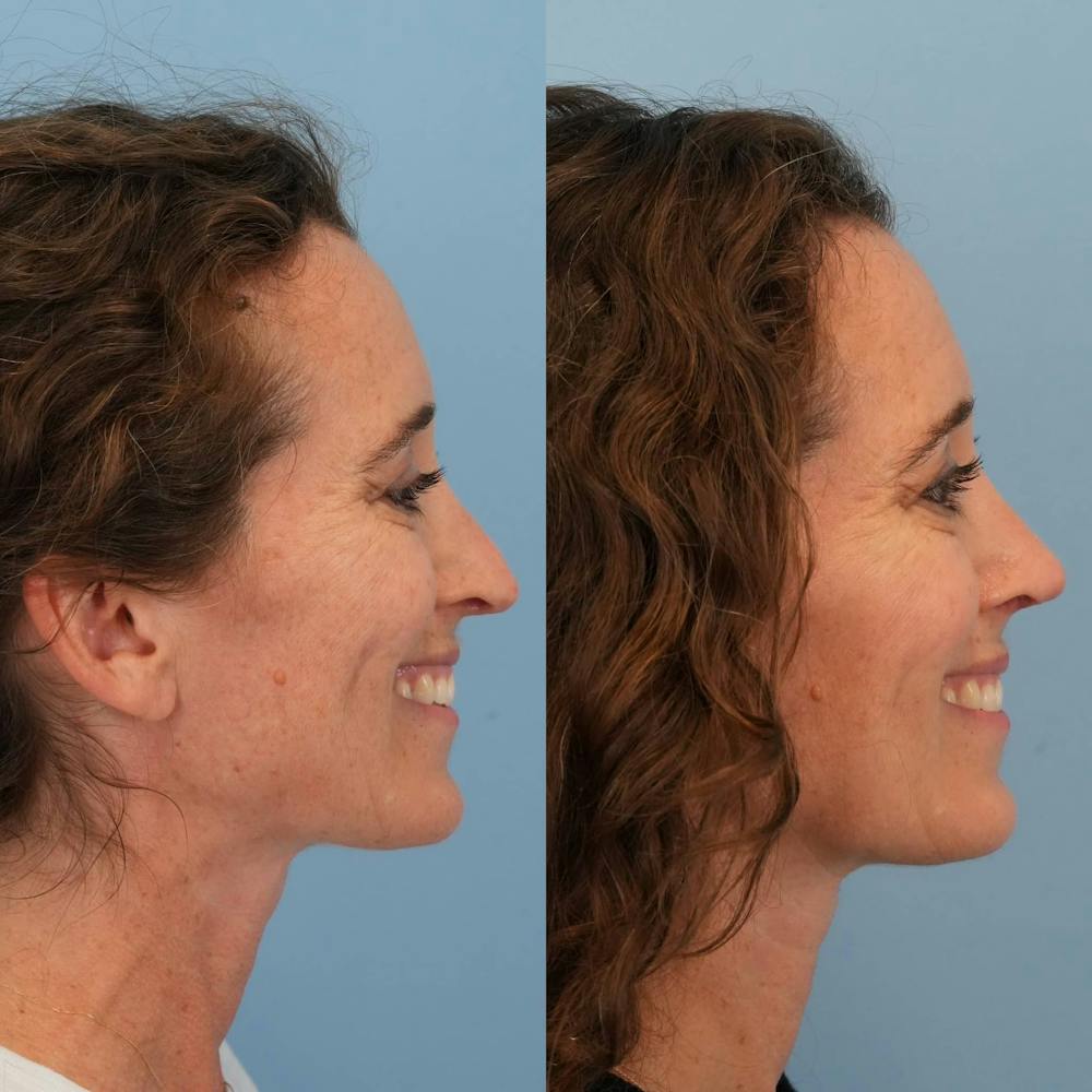 Revision Rhinoplasty Before & After Gallery - Patient 153460 - Image 7