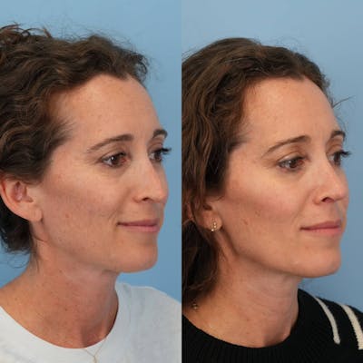 Revision Rhinoplasty Before & After Gallery - Patient 153460 - Image 6
