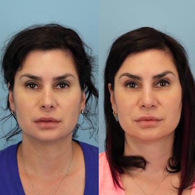 Revision Rhinoplasty Before & After Gallery - Patient 398240 - Image 4
