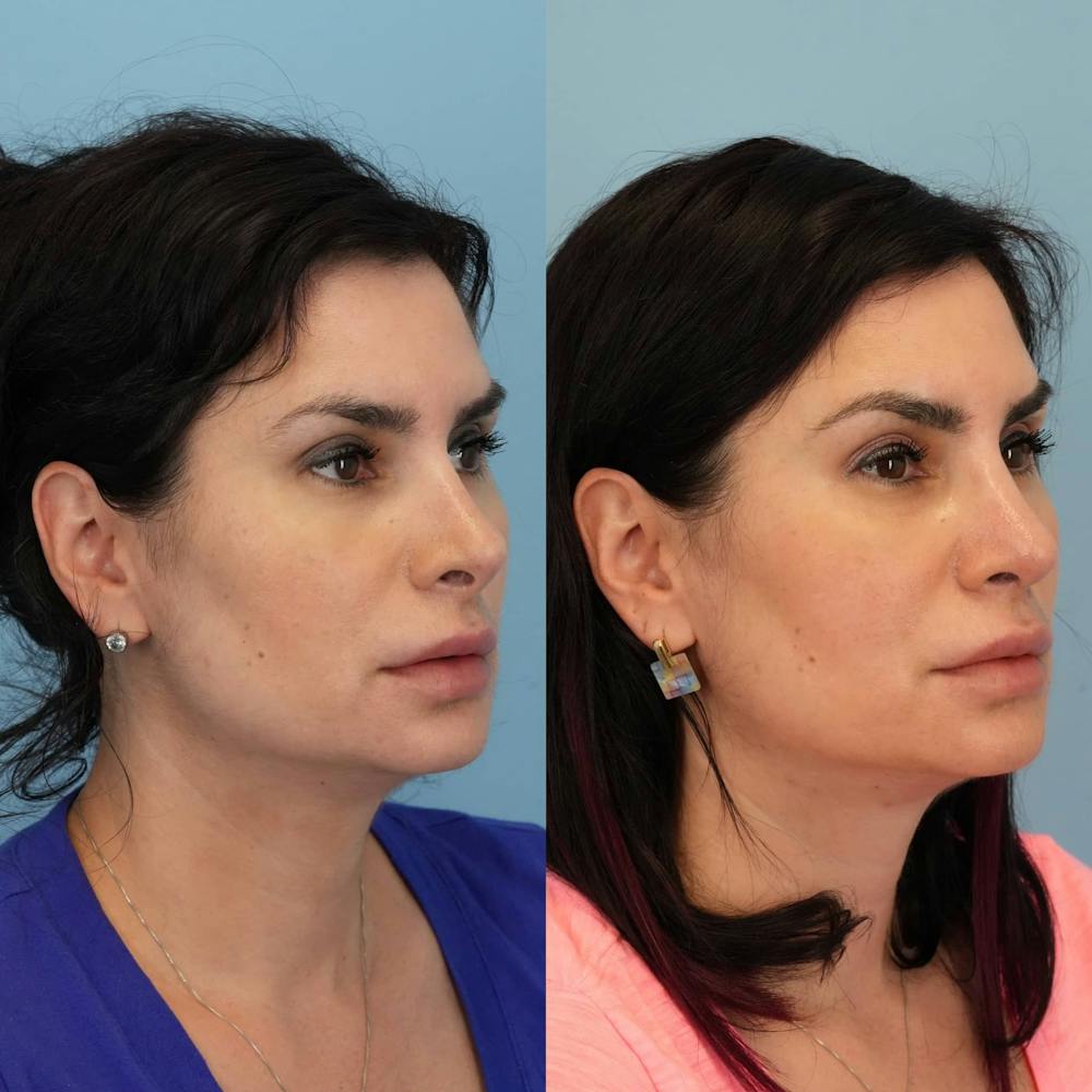 Revision Rhinoplasty Before & After Gallery - Patient 398240 - Image 5