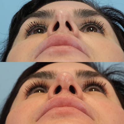 Revision Rhinoplasty Before & After Gallery - Patient 398240 - Image 8