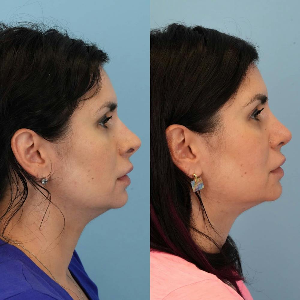 Revision Rhinoplasty Before & After Gallery - Patient 398240 - Image 6