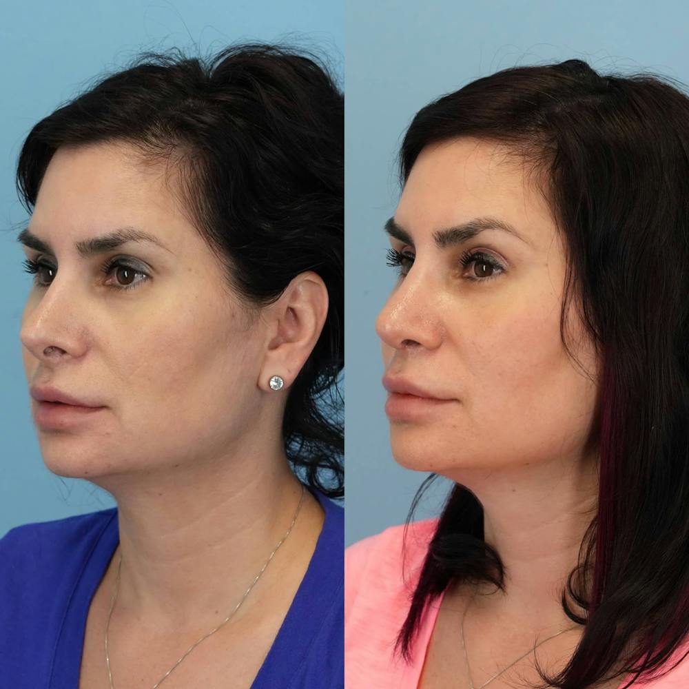 Revision Rhinoplasty Before & After Gallery - Patient 398240 - Image 3