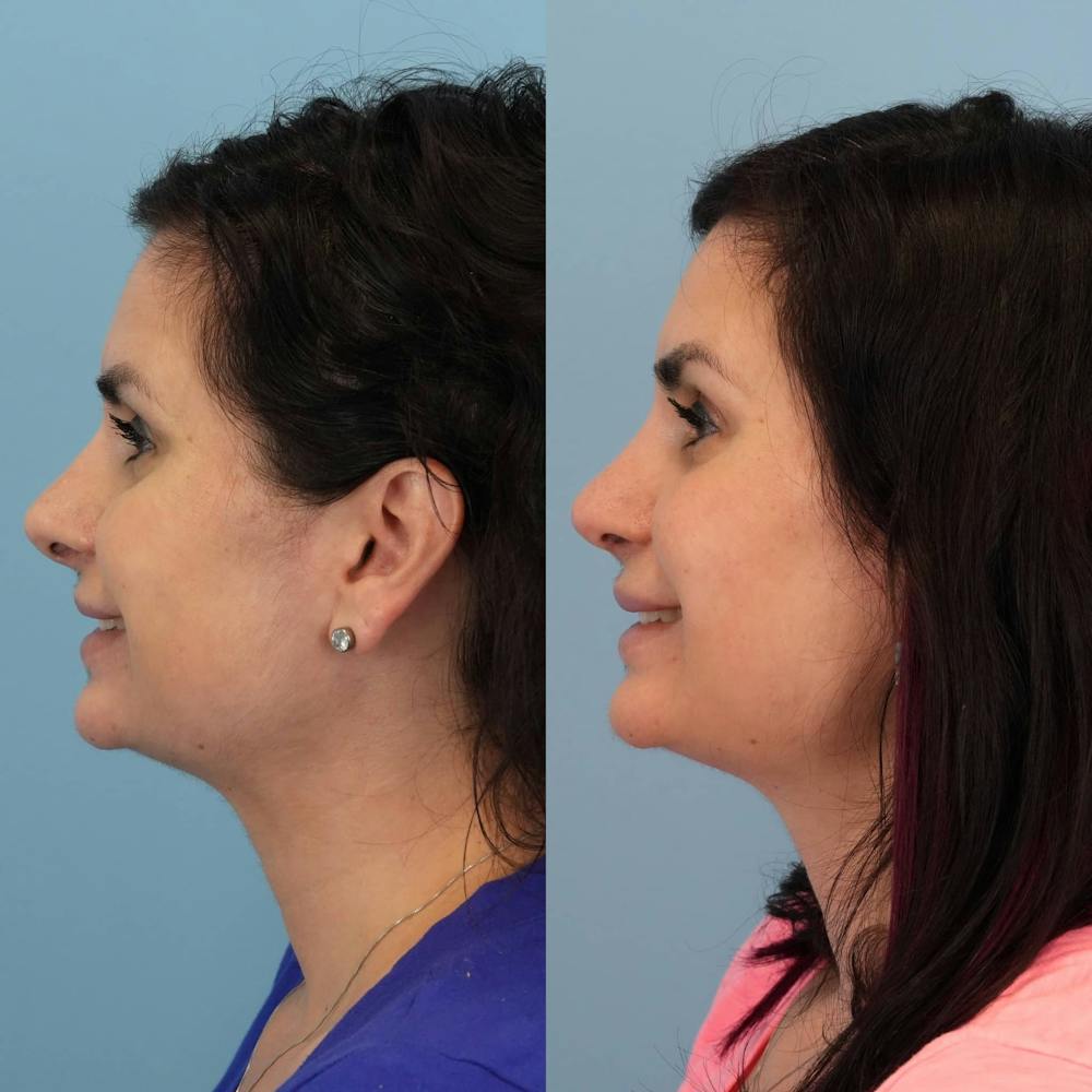 Revision Rhinoplasty Before & After Gallery - Patient 398240 - Image 2
