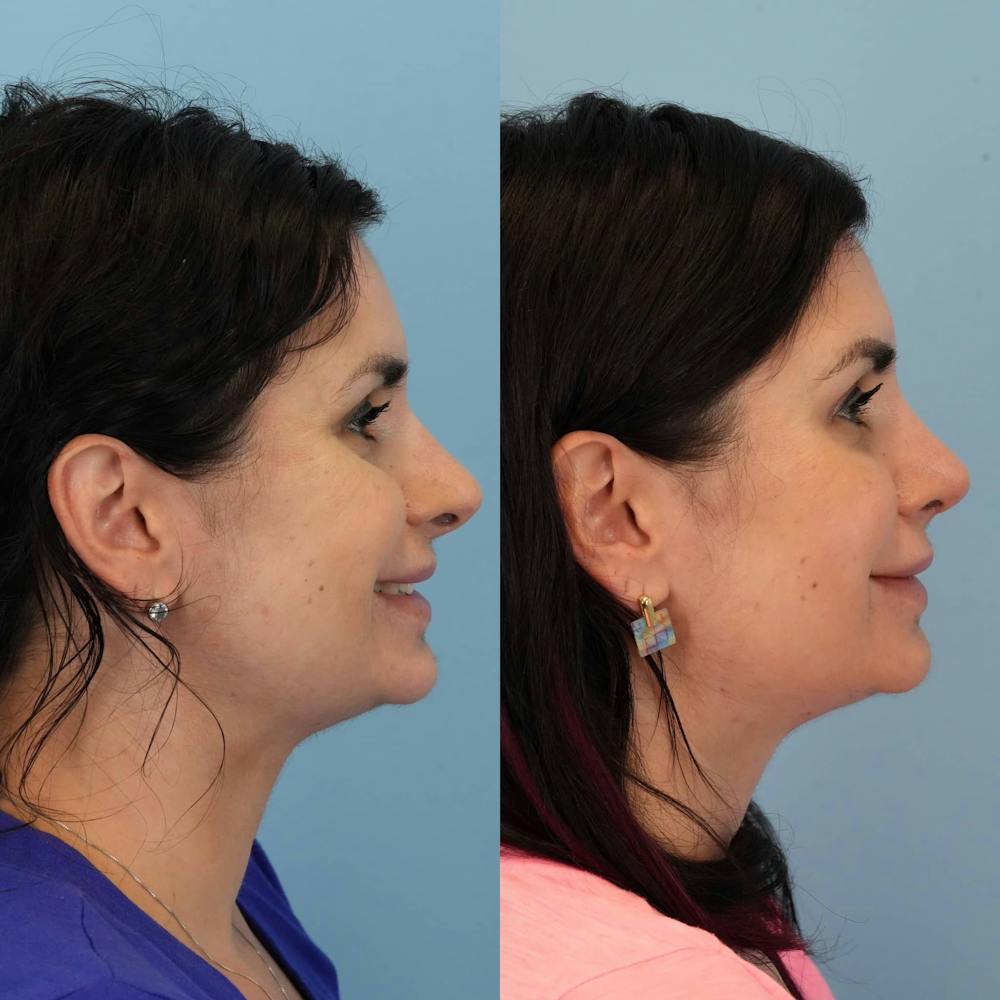 Revision Rhinoplasty Before & After Gallery - Patient 398240 - Image 7