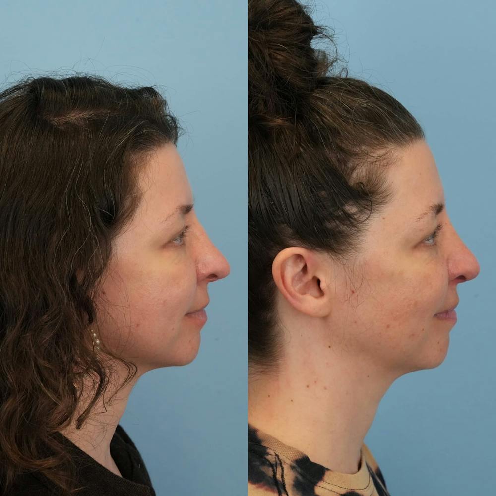 Revision Rhinoplasty Before & After Gallery - Patient 371024 - Image 5