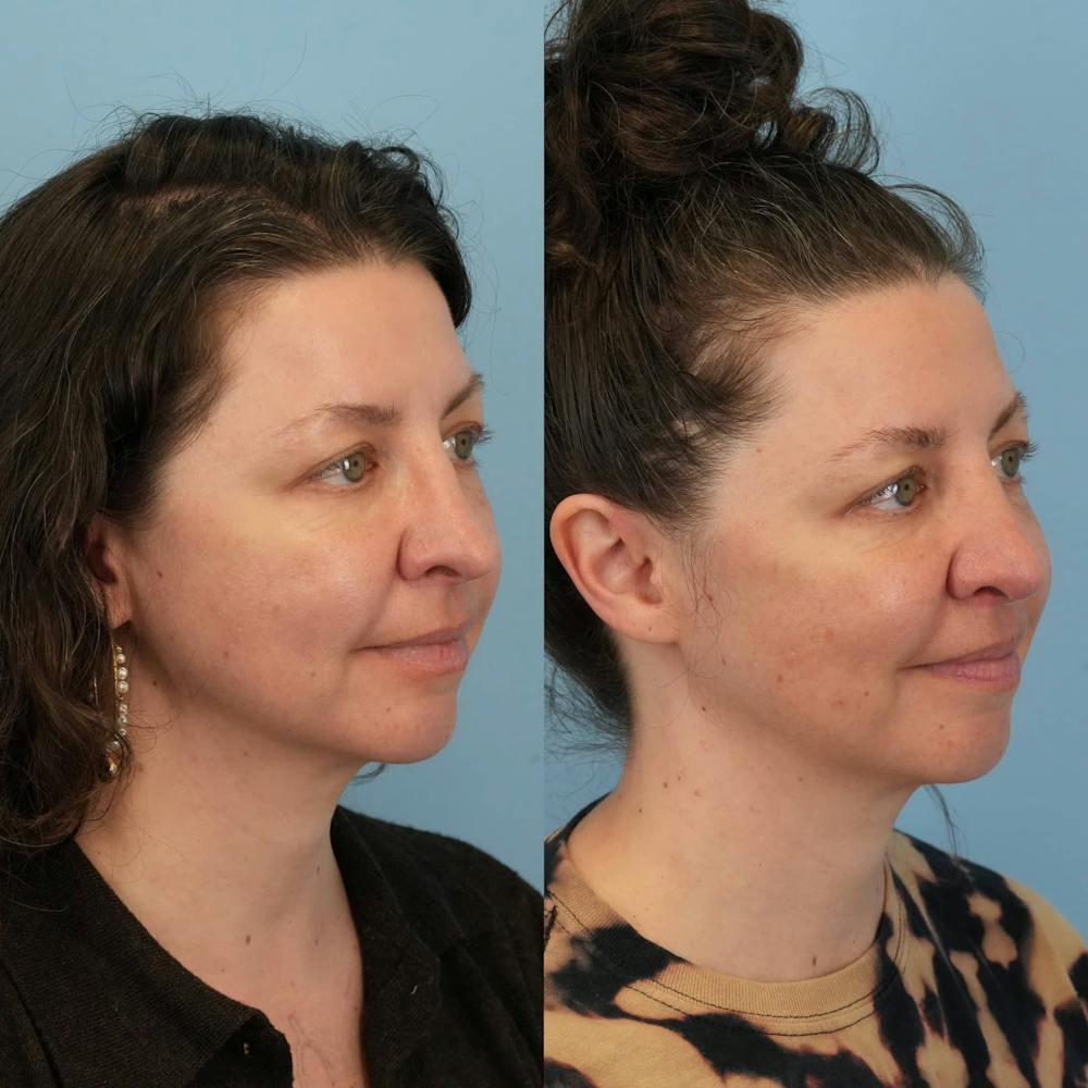 Revision Rhinoplasty Before & After Gallery - Patient 371024 - Image 6