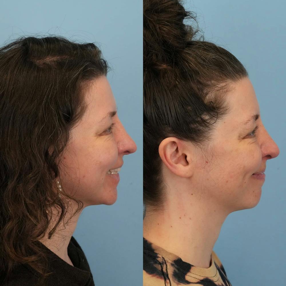 Revision Rhinoplasty Before & After Gallery - Patient 371024 - Image 7