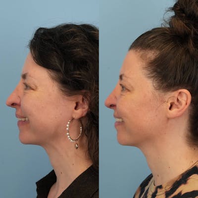 Revision Rhinoplasty Before & After Gallery - Patient 371024 - Image 2