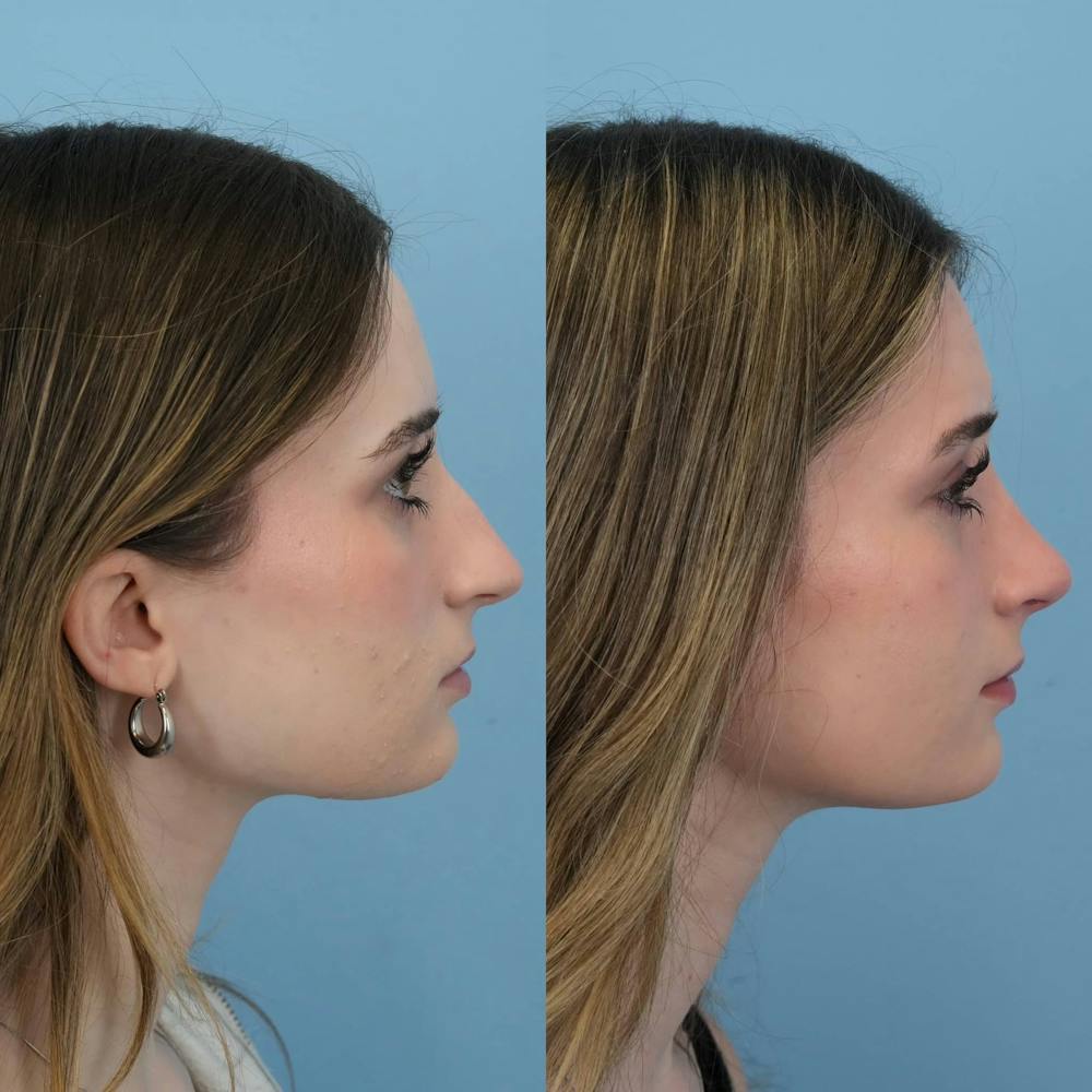 Rhinoplasty Before & After Gallery - Patient 325181 - Image 6