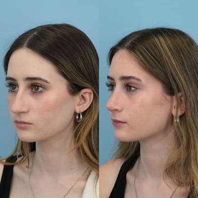 Rhinoplasty Before & After Gallery - Patient 325181 - Image 4