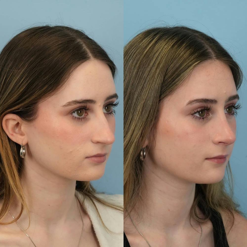 Rhinoplasty Before & After Gallery - Patient 325181 - Image 5
