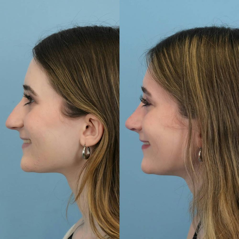 Rhinoplasty Before & After Gallery - Patient 325181 - Image 3