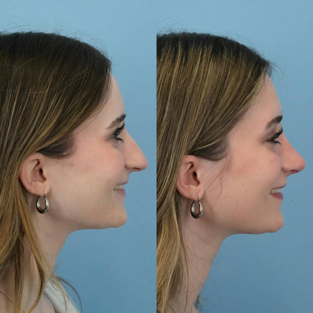 Rhinoplasty Before & After Gallery - Patient 325181 - Image 7