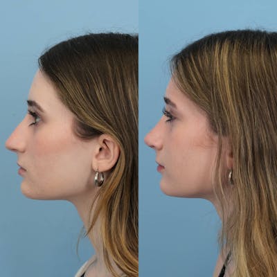 Rhinoplasty Before & After Gallery - Patient 325181 - Image 2