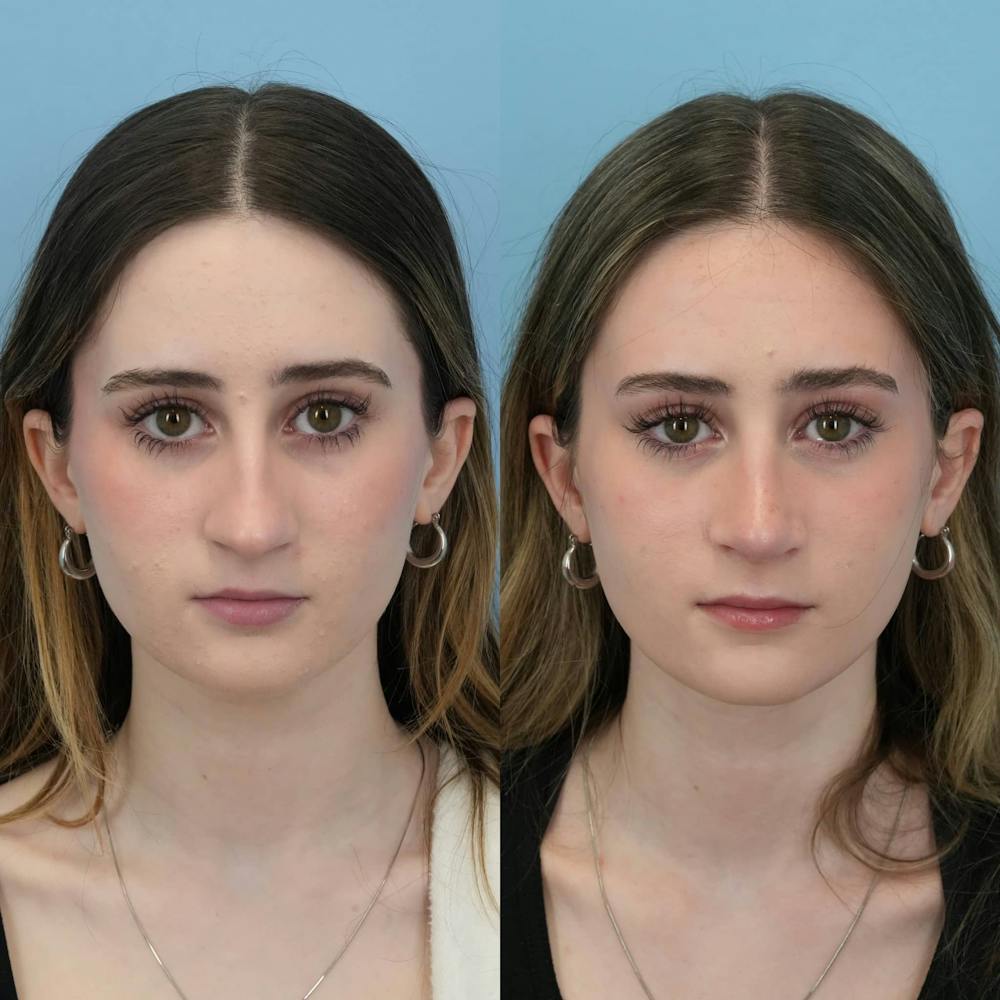 Rhinoplasty Before & After Gallery - Patient 325181 - Image 1