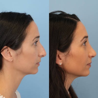 Rhinoplasty Before & After Gallery - Patient 403209 - Image 2
