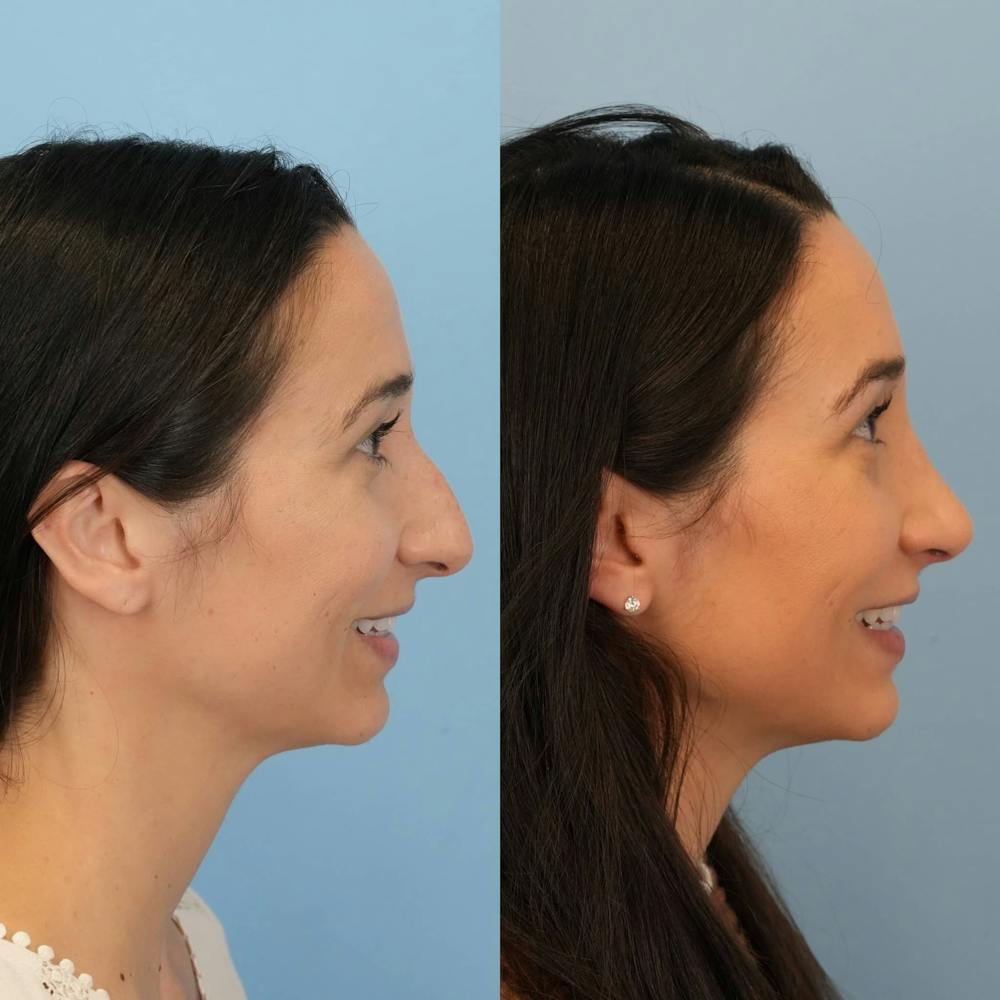Rhinoplasty Before & After Gallery - Patient 403209 - Image 3