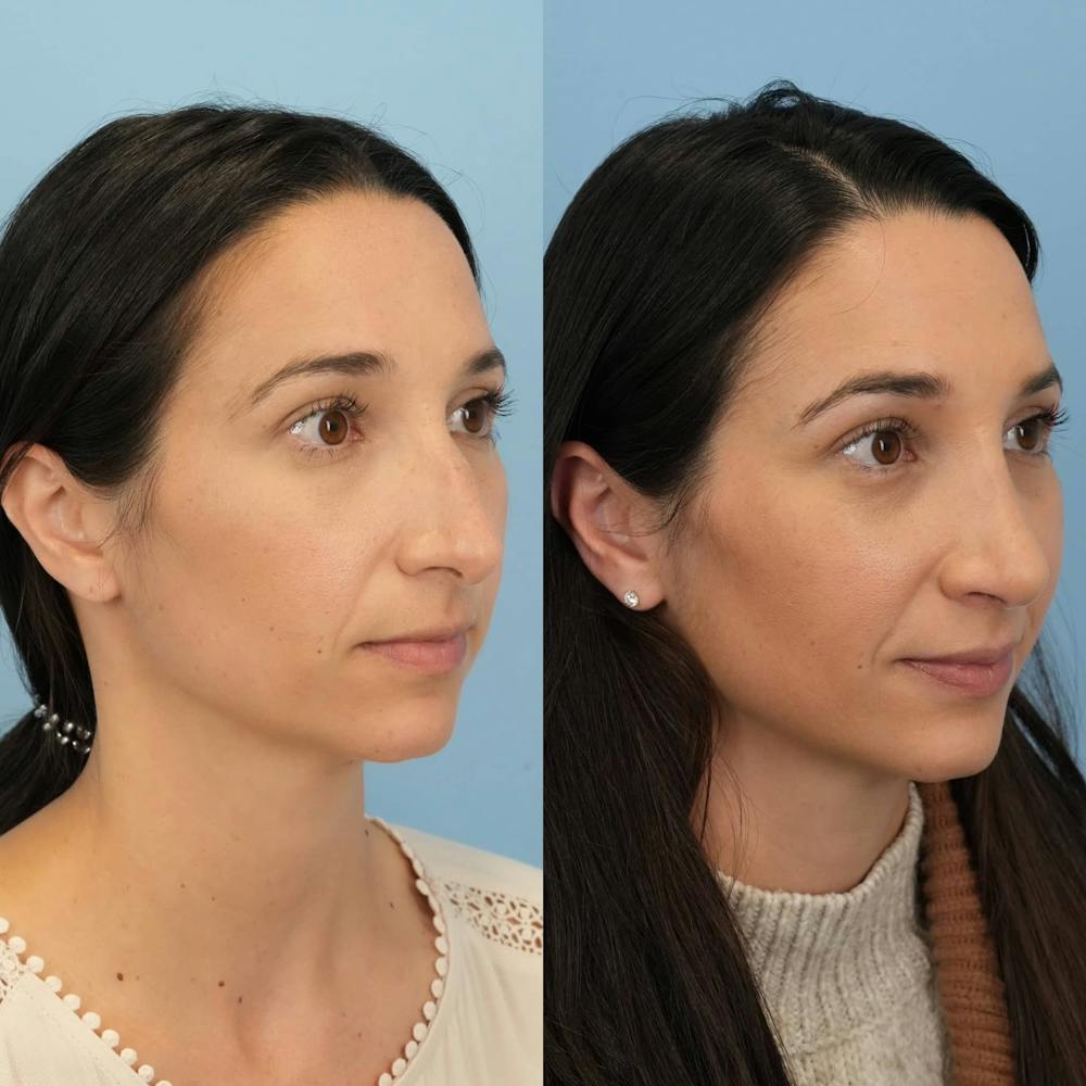 Rhinoplasty Before & After Gallery - Patient 403209 - Image 4