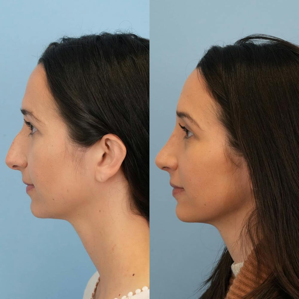 Rhinoplasty Before & After Gallery - Patient 403209 - Image 6
