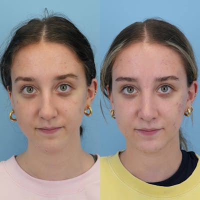 Rhinoplasty Before & After Gallery - Patient 444274 - Image 1