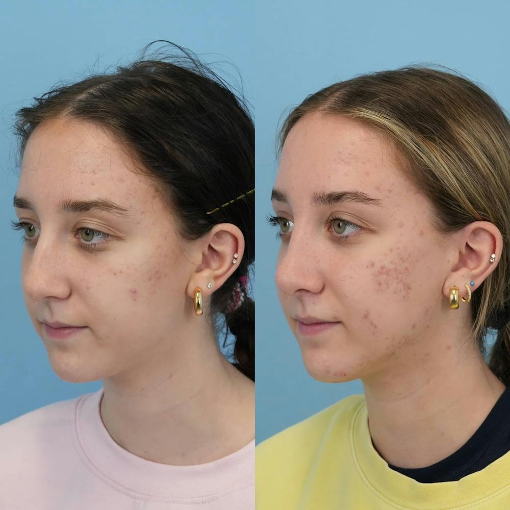 Rhinoplasty Before & After Gallery - Patient 444274 - Image 3