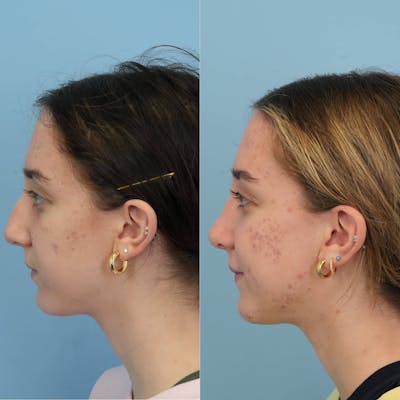 Rhinoplasty Before & After Gallery - Patient 444274 - Image 4