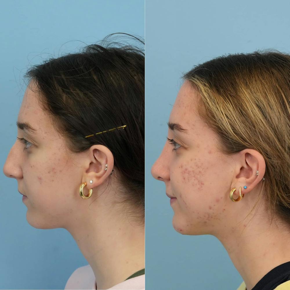 Rhinoplasty Before & After Gallery - Patient 444274 - Image 4
